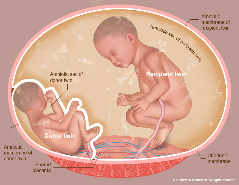 Twin To Twin Transfusion Syndrome (TTTS) Treatment - Children's Minnesota