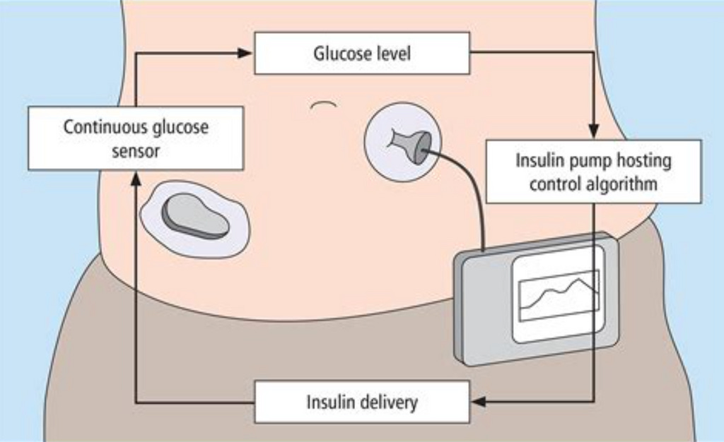 Diagram showing hybrid closed loop for insulin management.