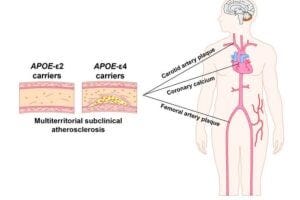 Individuals who carry the APOE4 gene variant have an elevated riskof developing subclinical atherosclerosis in middle age, whereas carriers of the variant APOE2 are protected.