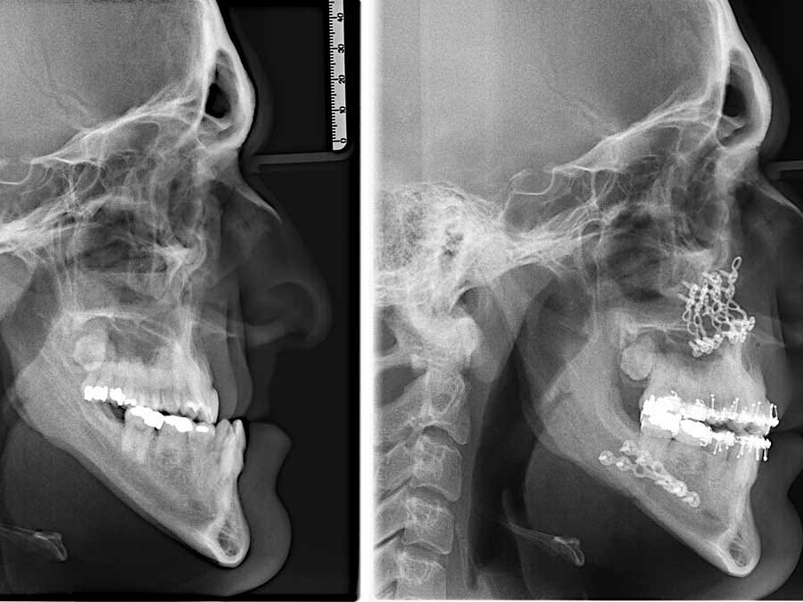 Journeying through the Process of Corrective Jaw Surgery: What to Expect »  Head & Neck Surgical Associates