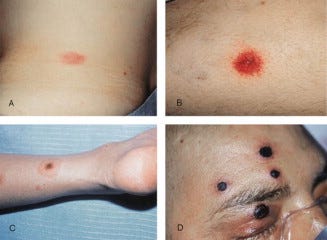 Skin lesions associated with Fusarium infection - ScienceDirect
