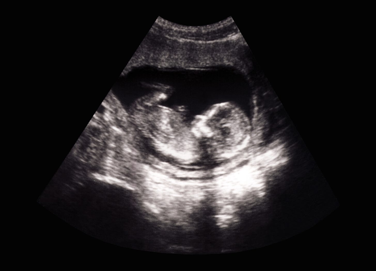 Ultrasound of baby, psychic abortions