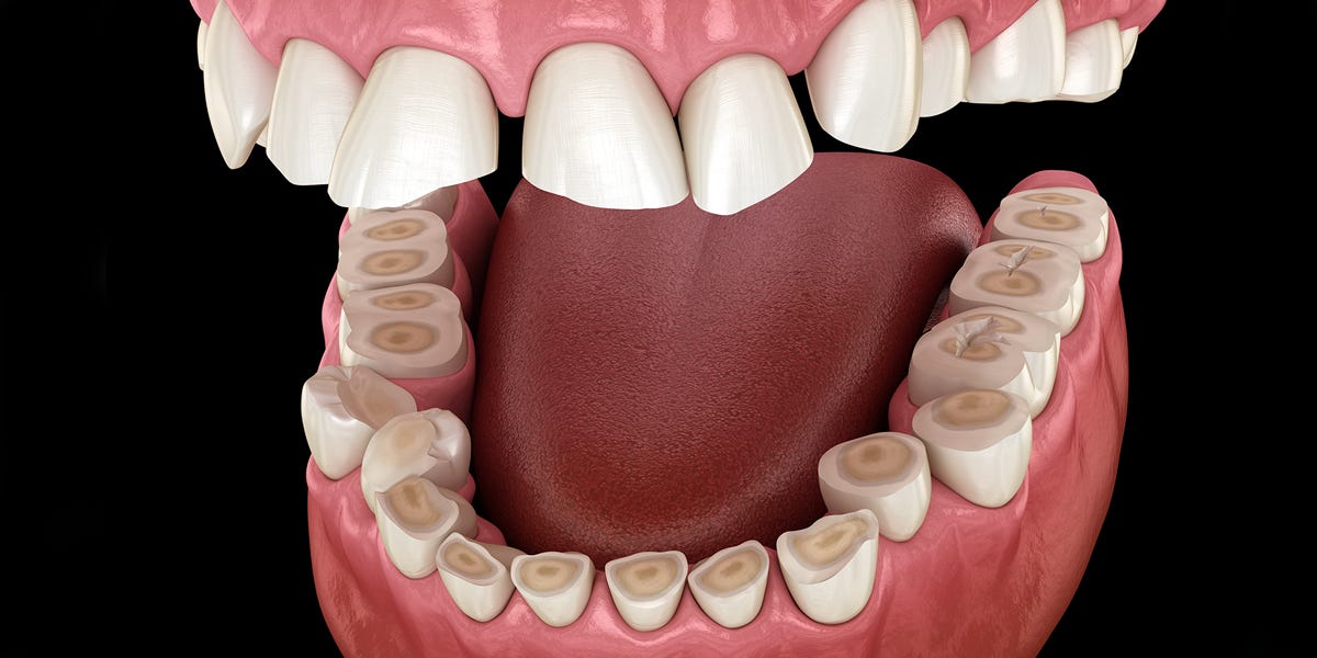 Teeth Grinding (Bruxism) - Eastern Dental