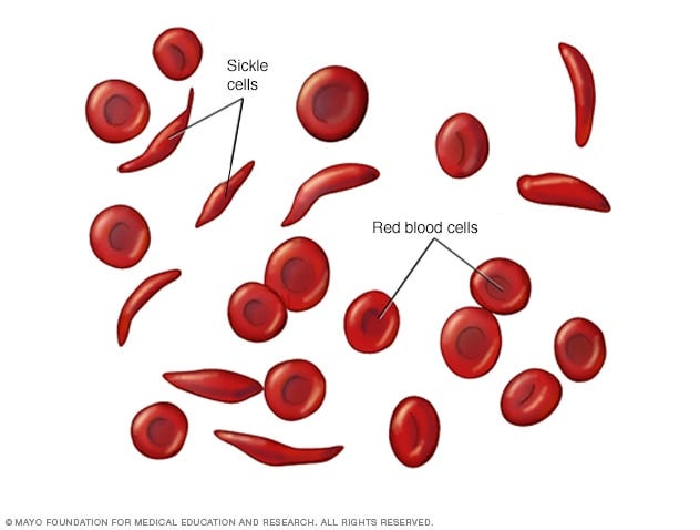 Sickle cell anemia - Symptoms & causes - Mayo Clinic