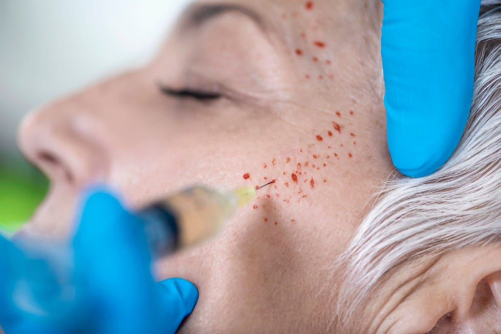 What Is a Vampire Facial, and Who Can Benefit From It?
