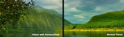 Image result for keratoconus