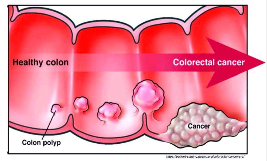 Polyp to cancer