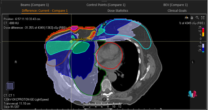 Excess radiation from an IMRT plan compared to a Proton Therapy Partial Breast Cancer Treatment.