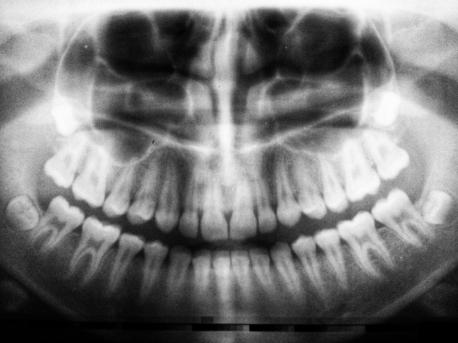 Panoramic X-ray image of human teeth in the upper and lower jaws Panoramic X-ray image of human teeth in the upper and lower jaws
