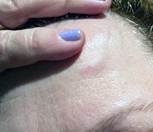 photo of minor head injury bruise