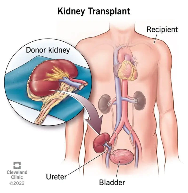 Kidney Transplant: Surgery, Purpose, Procedure & Recovery