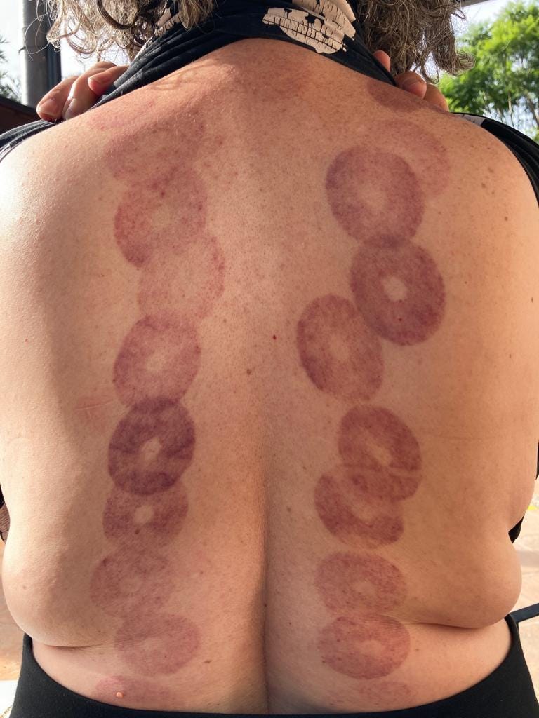 A woman with back fat love handles and circles from cupping along both sides of her spine.