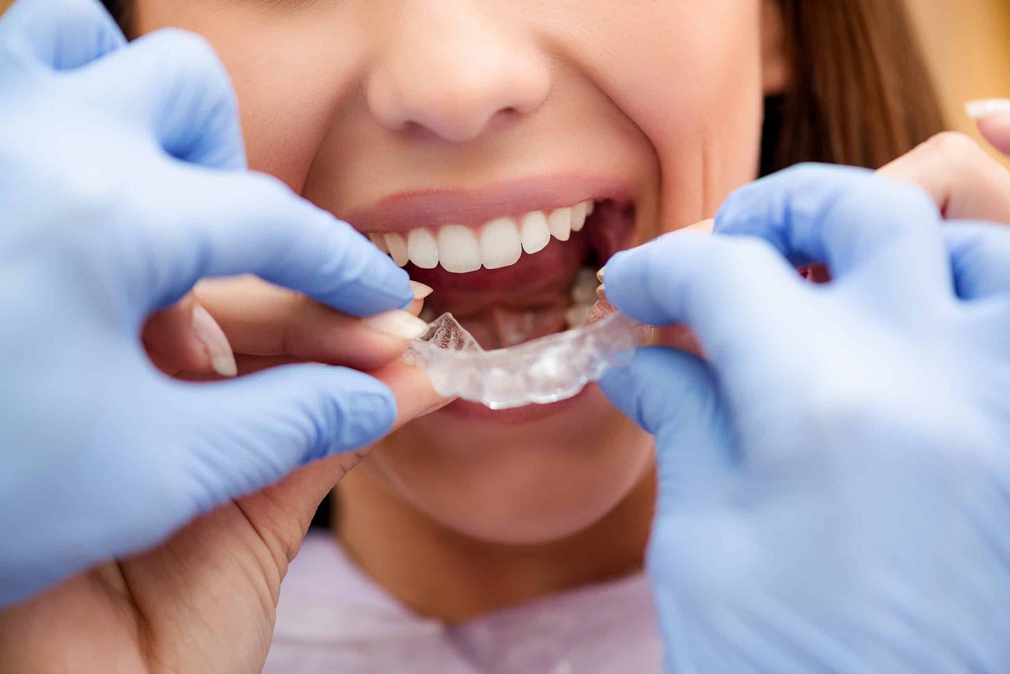 Occlusal Splints - Dentists at Pymble