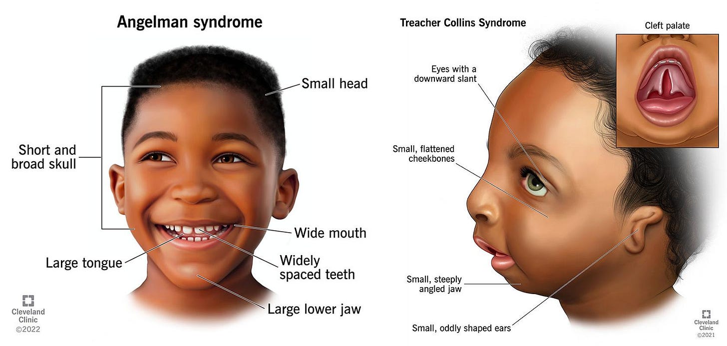 Side-by-side medical illustrations of two children with distinct facial features associated with Angelman syndrome and Treacher Collins syndrome. The child with Angelman syndrome has a small head, wide mouth, large tongue, and widely spaced teeth, while the child with Treacher Collins syndrome shows downward-slanting eyes, small cheekbones, and a steeply angled jaw.