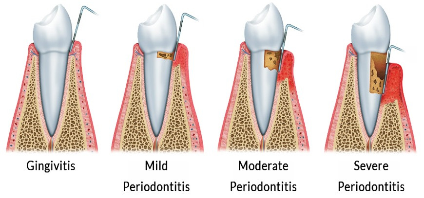 Levels of Periodontitis - Finest Dental Studio in Winchmore Hill London