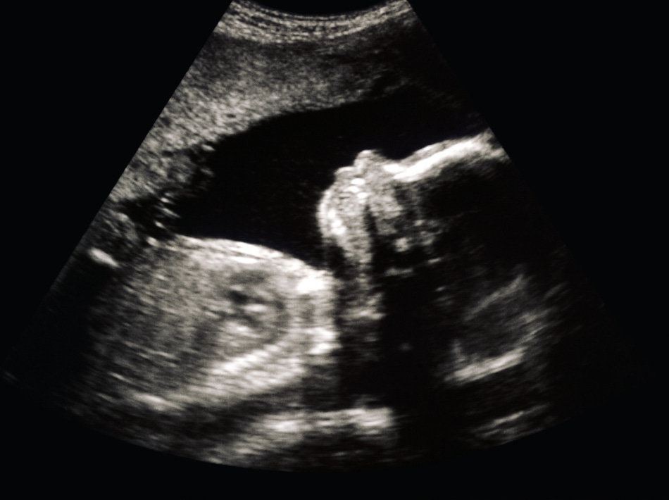 sonogram of preborn baby