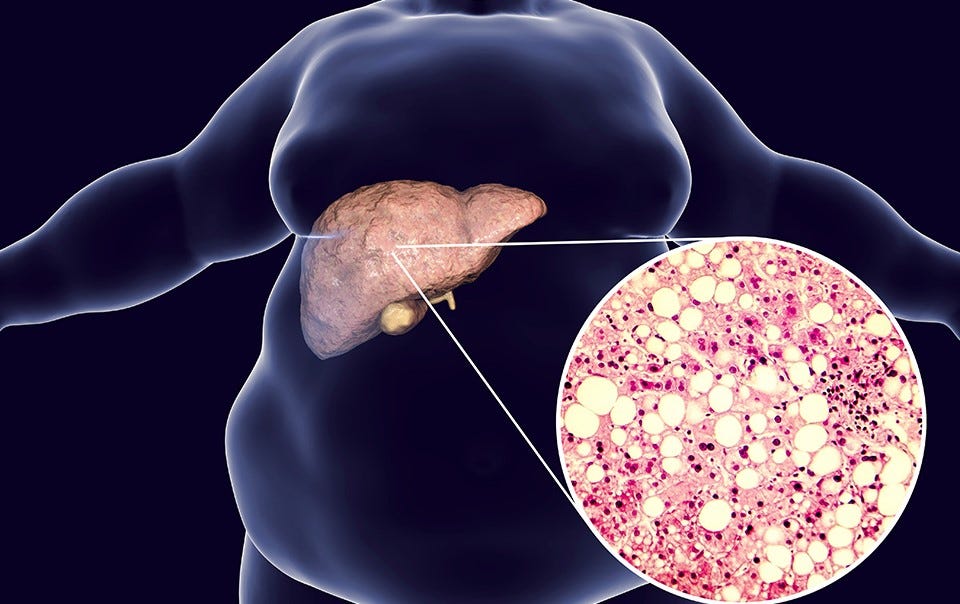 Non-alcoholic Fatty Liver Disease | Oxford Gut and Liver