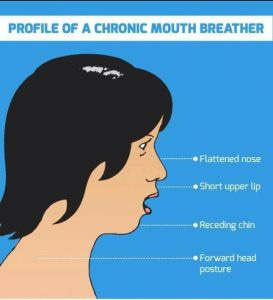 Mouth Breather Face-What Causes it and How to Fix it