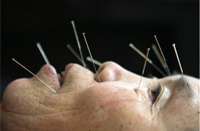 Acupuncture for Sinus Issues | Westside Head & Neck