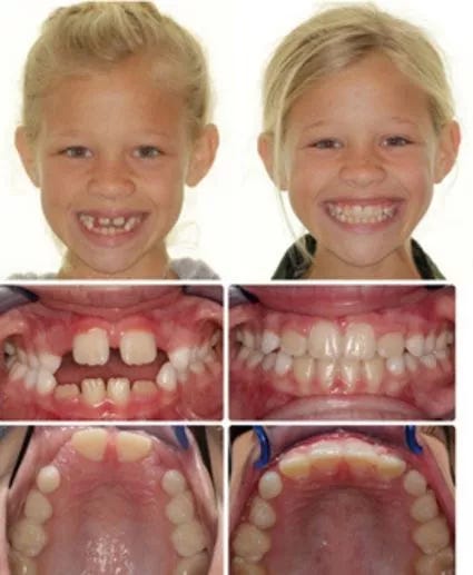 Dr. Victoria Lynskey | Santa Rosa, CA Orthodontist | Palatal Expanders