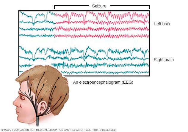 EEG (electroencephalogram) - Mayo Clinic