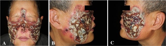 Disfiguring Mucor irregularis Infection Cured by Amphotericin B and  Itraconazole: A Case Report and Treatment Experience | SpringerLink