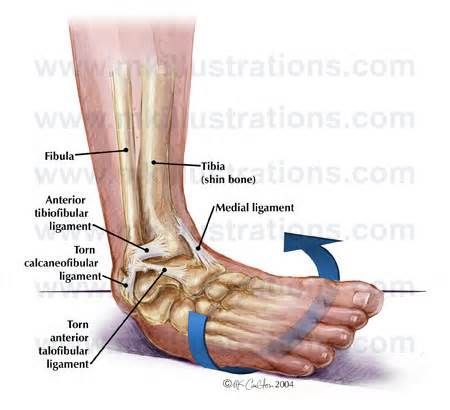 TWISTED ANKLE TREATMENT 1 - Muscle Pull | Muscle Pull