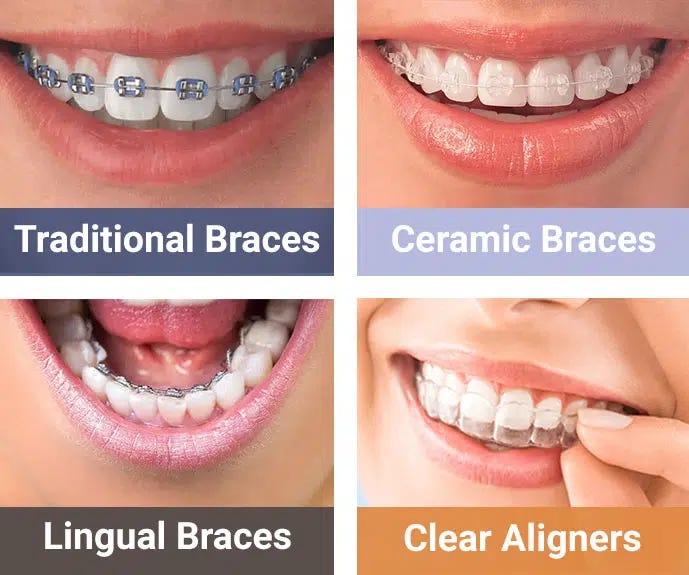 Dental Braces NYC (Ceramic, Clear) | Gibbs Orthodontics