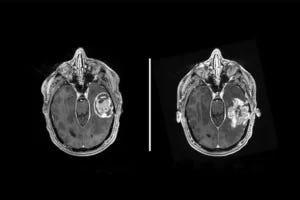 Researchers at WashU Medicine have identified a possible way to make glioblastoma cells vulnerable to different types of immunotherapy. The strategy, which they demonstrated in cells in the lab, forces brain cancer cells to display targets for the immune system to attack. Glioblastoma is one of the most aggressive cancers, as illustrated by these brain scans from a patient with glioblastoma at initial diagnosis (left) and the same patient with a recurrent tumor (right).