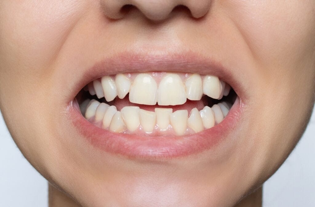 The Best Ways to Fix Slightly Crooked Teeth | St. Albert
