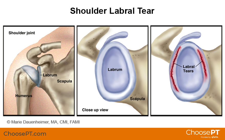 Guide | Physical Therapy Guide to Shoulder Labral Tear | Choose PT