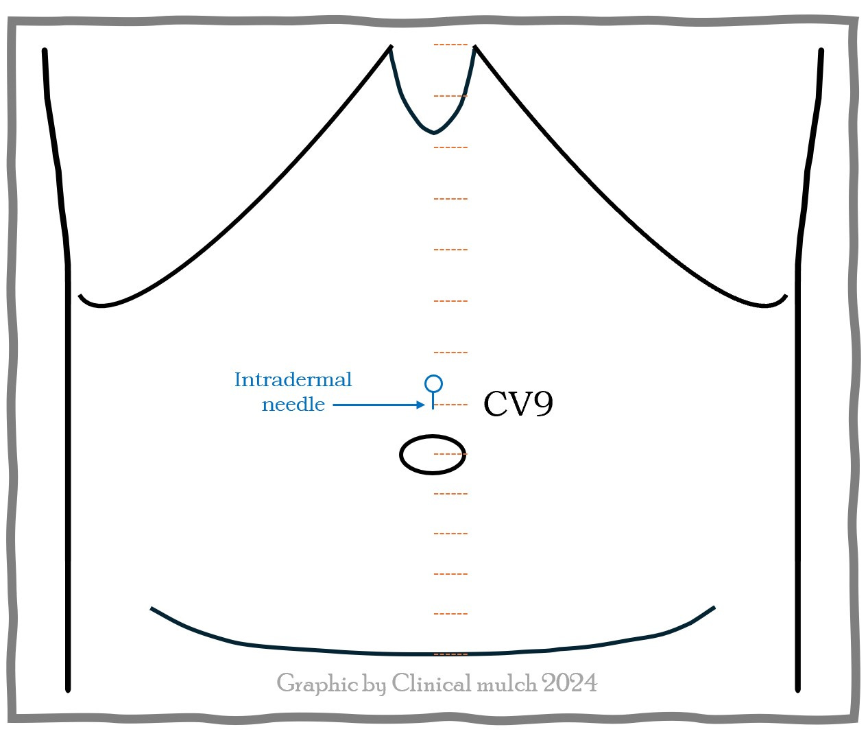 diagram depicting an abdomen from the ribcage to the pubic symphysis, with a small intradermal needle over the navel and the alphanumeric CV9 indicating the point name