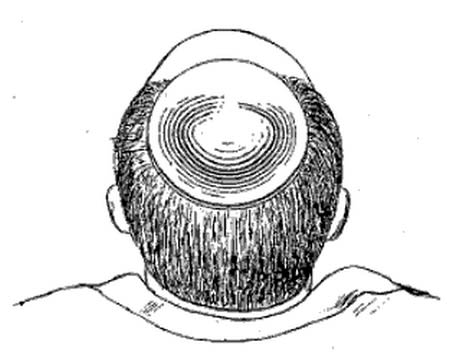 A view of the top of a person's head, shown in a simple line drawing. There is hair around the back of the head while the front is bald. On the crown of the head there is a round skull-cap.