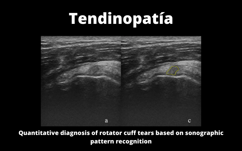 Tendinopatia Manguito Rotador.png