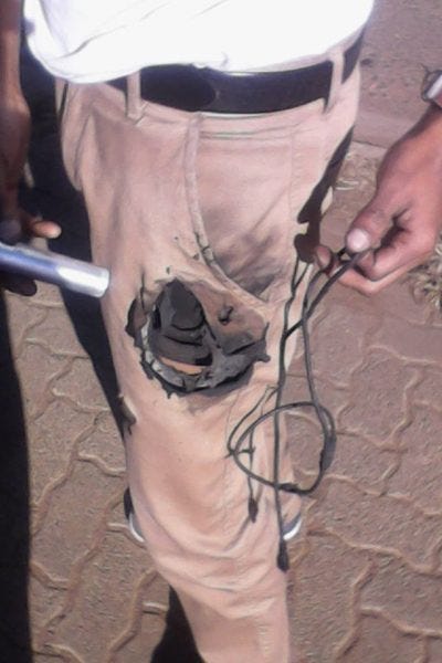 mans gets burned pocket hole from samsung note 7