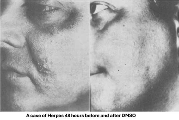 dmso herpes face