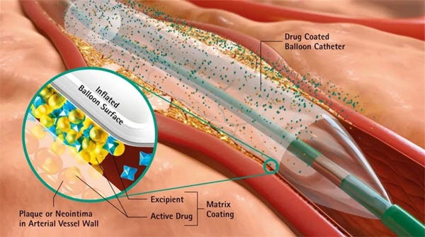 Clinical Application of Drug-Coated Balloon in The Treatment of Coronary  Artery Disease - Kossel Medtech
