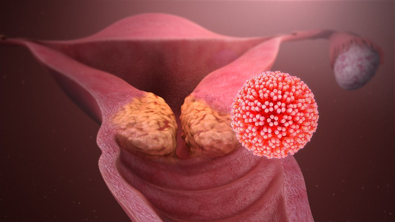 File:HPV causing cervical cancer.jpg - Wikipedia