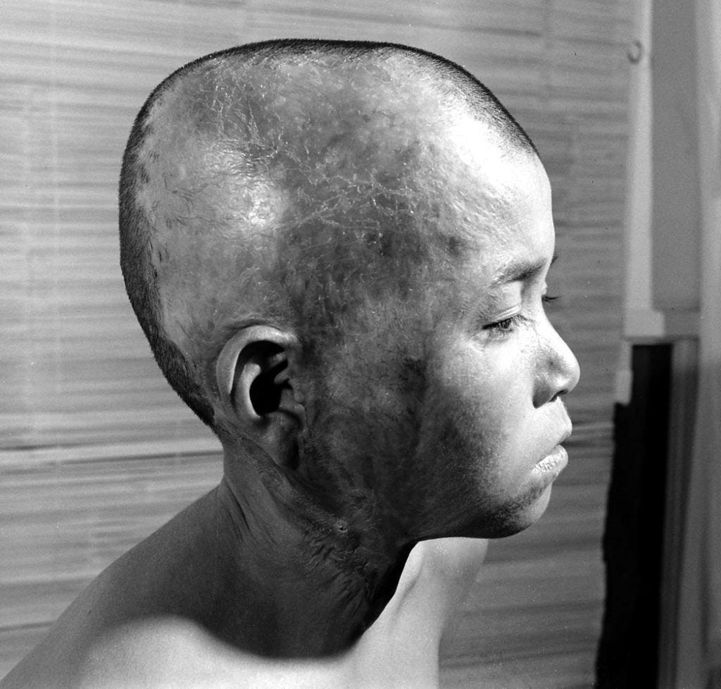 A boy badly burned by the Hiroshima bomb four years earlier, seen in 1949.