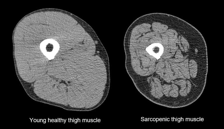 World Sarcopenia Day: Do You Have Enough Muscles?