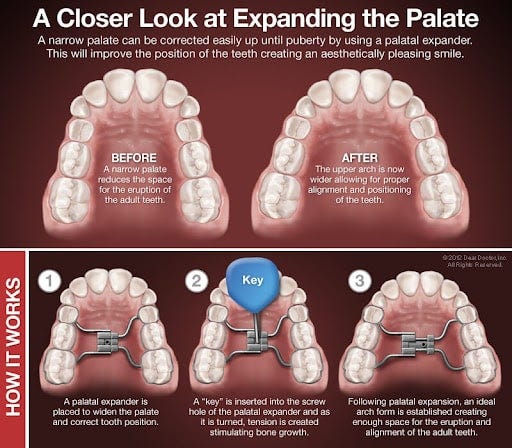 What to Expect During Treatment With a Palatal Expander | Bernstein  Orthodontics