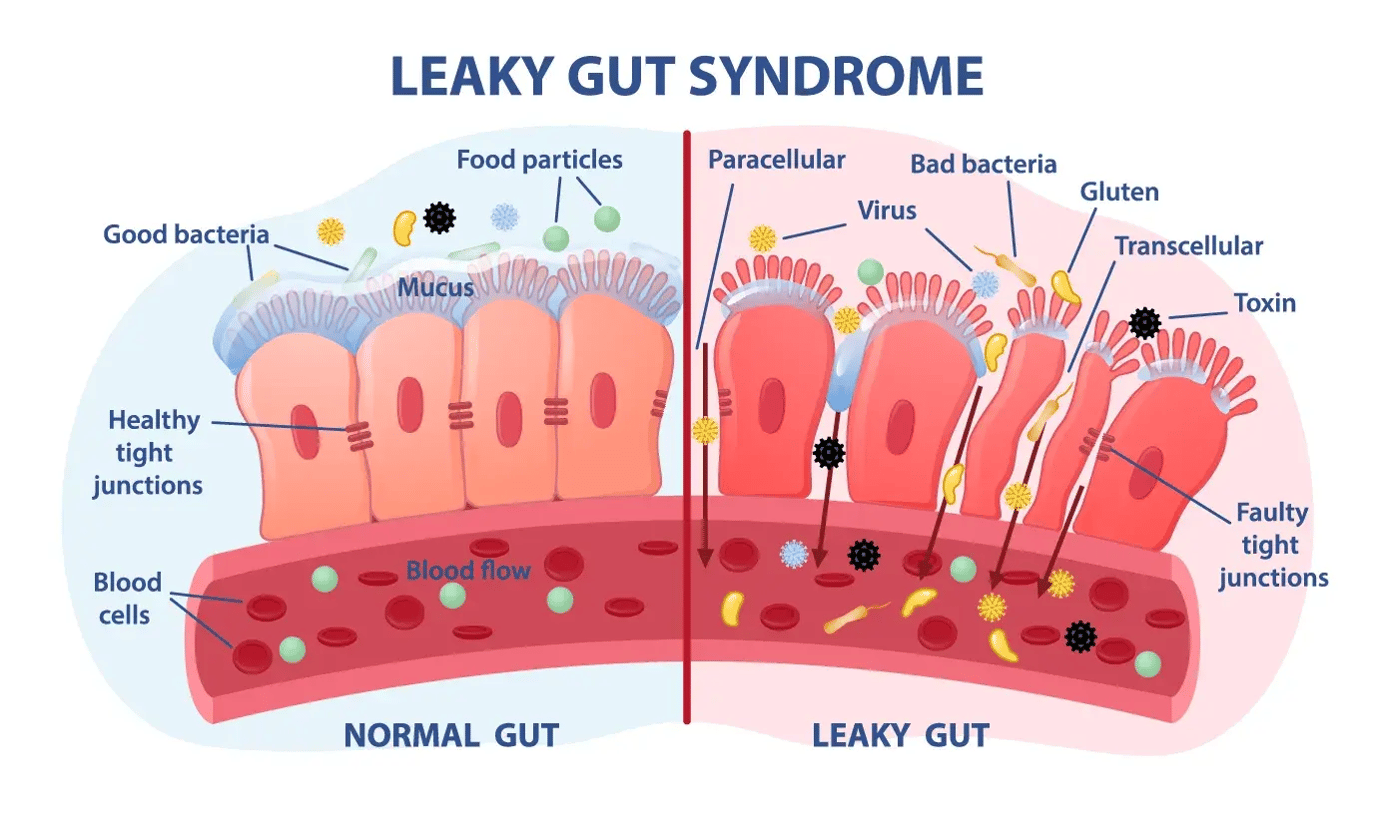 The role of Zonulin-mediated gut permeability in IBD