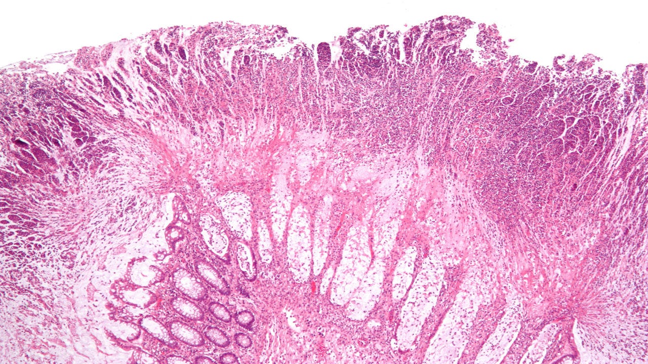 magnification of colonic pseudomembranes
