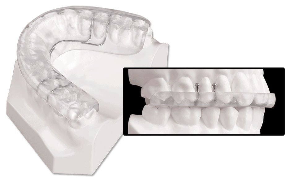 Orthopedic Splints - DynaFlex