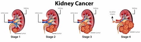 kidney cancer