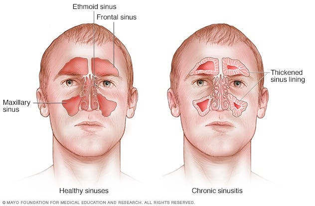 Chronic sinusitis - Symptoms and causes - Mayo Clinic