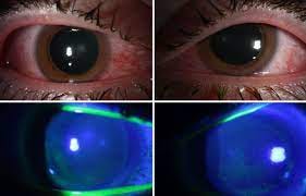 Doctors warn about eye damage from UV lights to kill the coronavirus