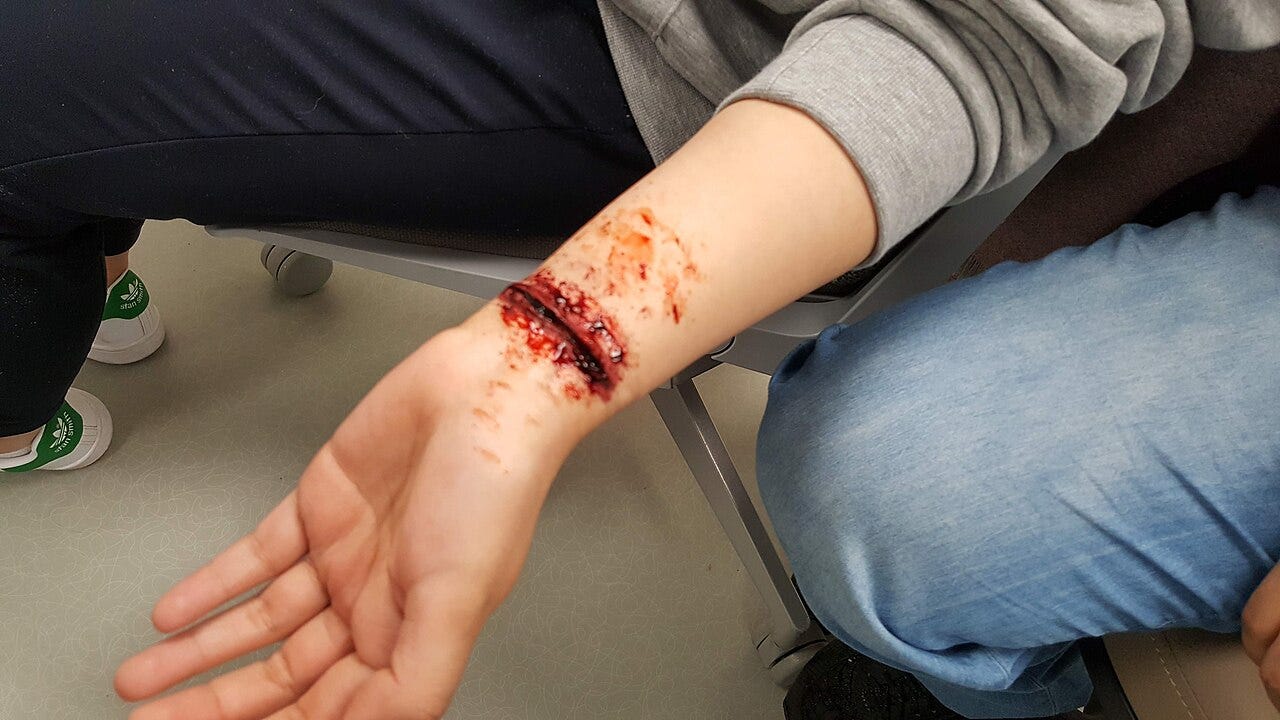 File:Healthcare Simulation Moulage Standardized Patient Actor Deep Gash  Wound Cut on Wrist.jpg - Wikimedia Commons