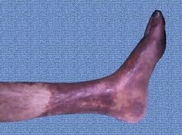 Herida con dolor desproporcionado — sospecha de isquemia