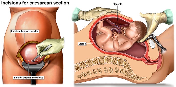 Caesarean (C-section) | Pregnancy Birth and Baby